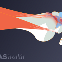 Shoulder impingement illustration