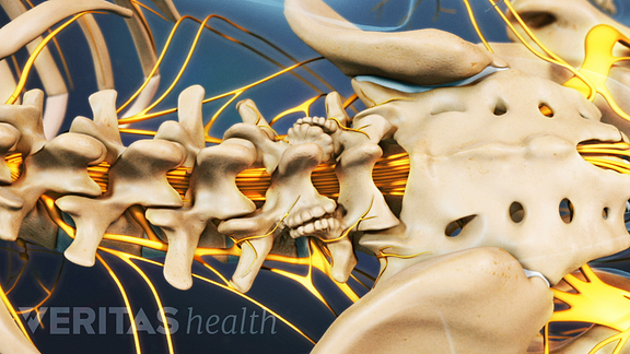 How Lumbar Degenerative Disc Disease Is Diagnosed