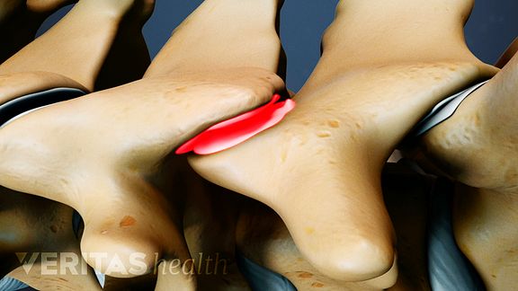Cervical Facet Osteoarthritis