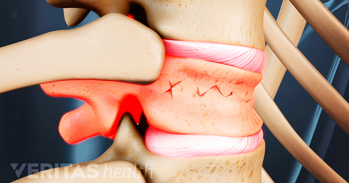 What You Should Know About Spinal Compression Fractures