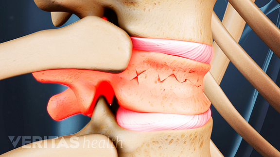 Spinal Compression Fracture Video