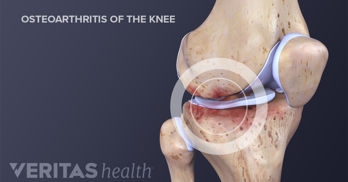 osteoarthritis knee