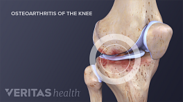 Medical illustration of osteoarthritic changes in the knee joint