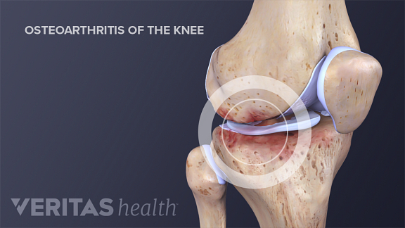 Lubricating Injections Can Soothe Knee Osteoarthritis