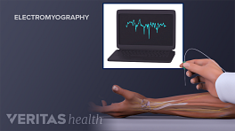 Electromyography of the forearm.