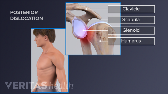 Posterior shoulder dislocation showing the clavicle, scapula, and glenoid.