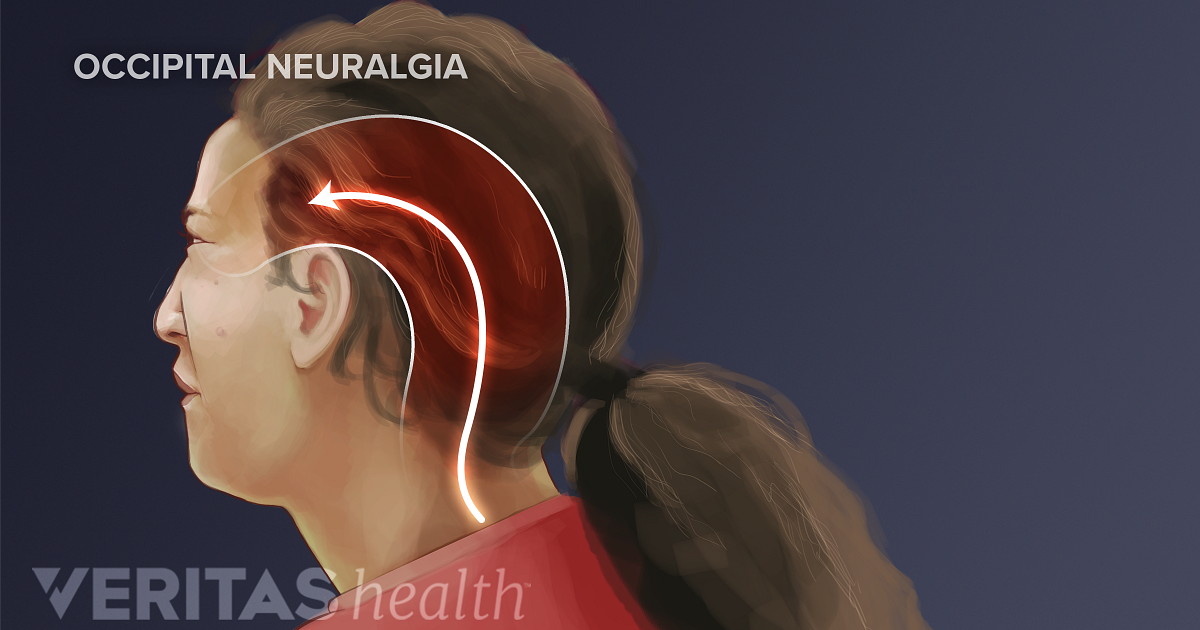 Occipital Neuralgia What It Is And How To Treat It 8483