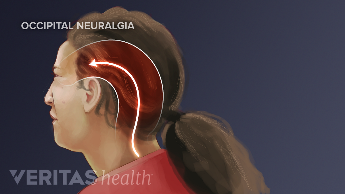 Occipital Neuralgia What It Is And How To Treat It