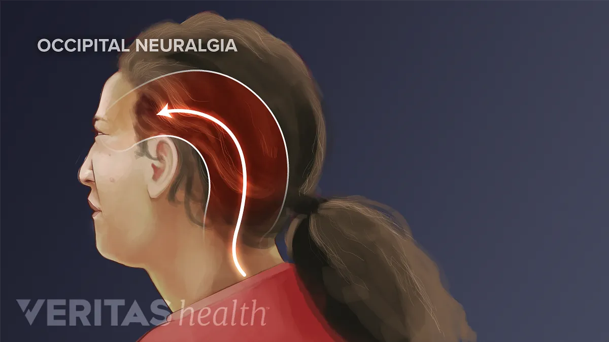Occipital Neuralgia What It Is And How To Treat It