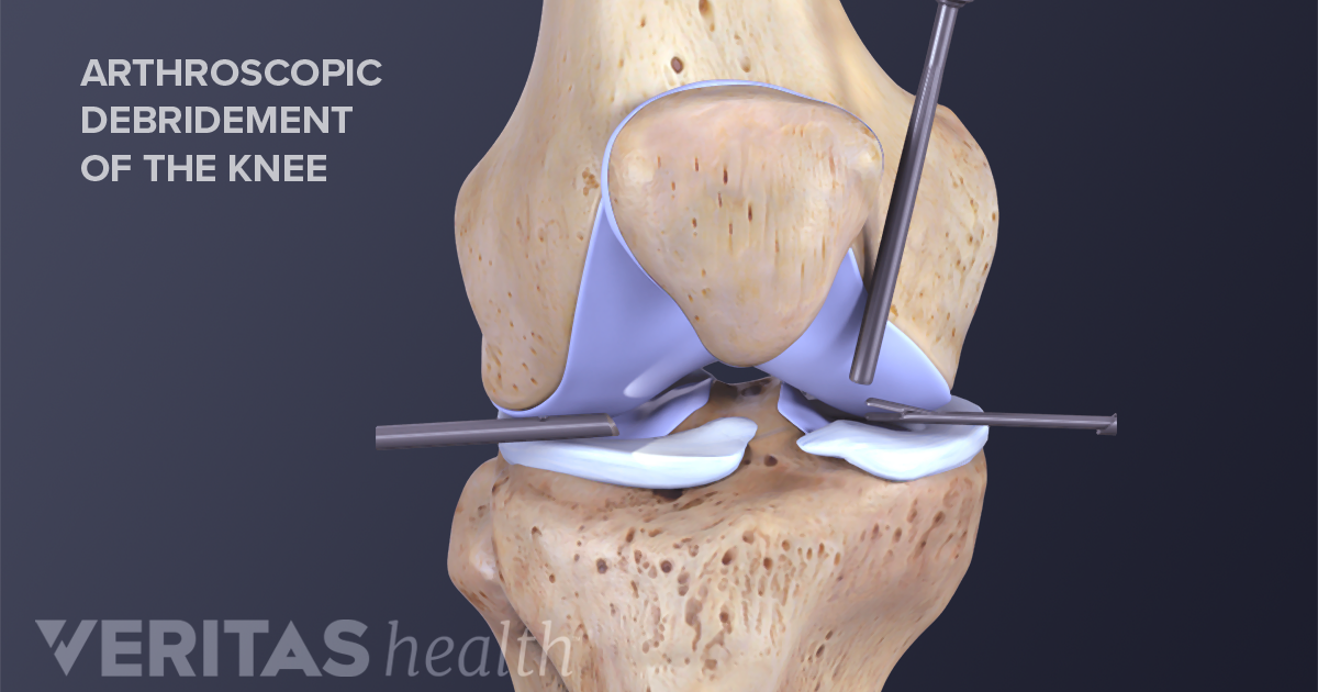 Treatment of Jumper’s Knee