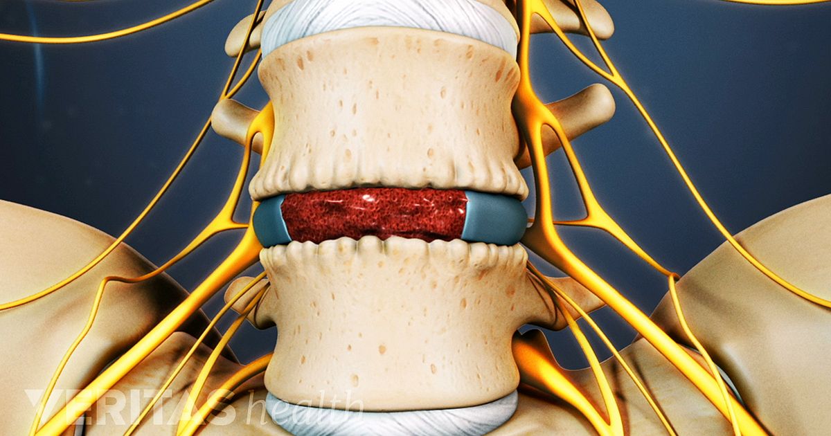 Anterior Lumbar Interbody Fusion Spinal Implants and Bone Grafts