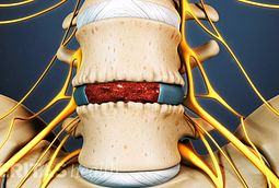 Transforaminal Lumbar Interbody Fusion (TLIF) Video