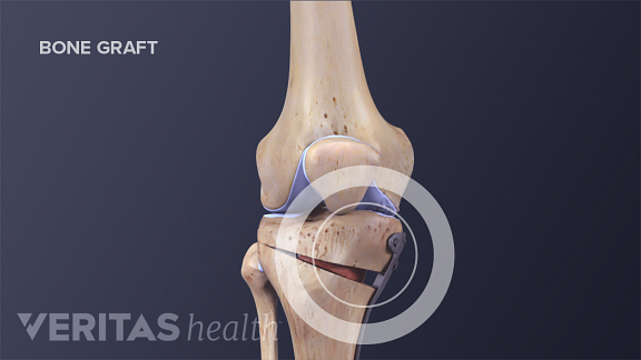 Types of Knee Surgery for Arthritis Treatment | Arthritis-Health