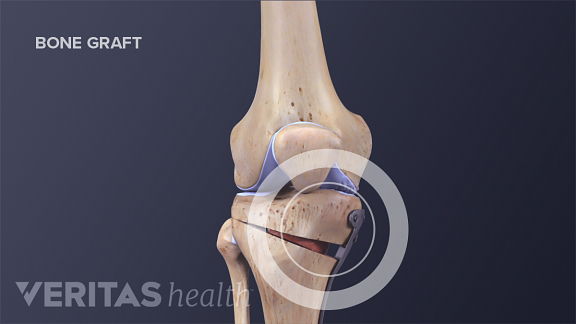 Tibial Osteotomy