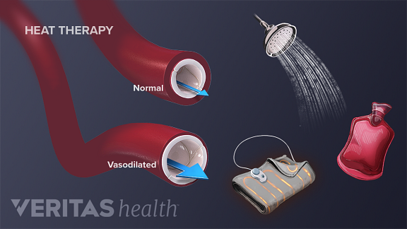 heat cold therapy