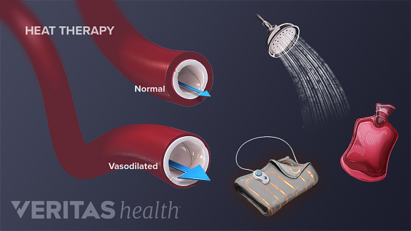 Medical illustration showing normal and vasilodated blood vessels as a response to different forms of heat therapy