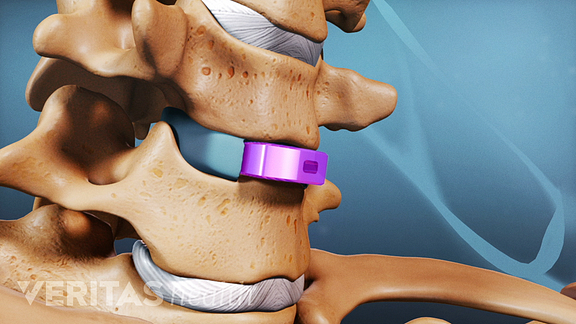 cage bone graft insertion.