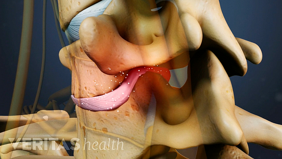 Cervical Degenerative Disc Disease
