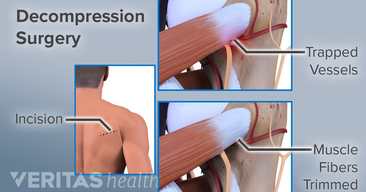 lumbar decompression back surgery