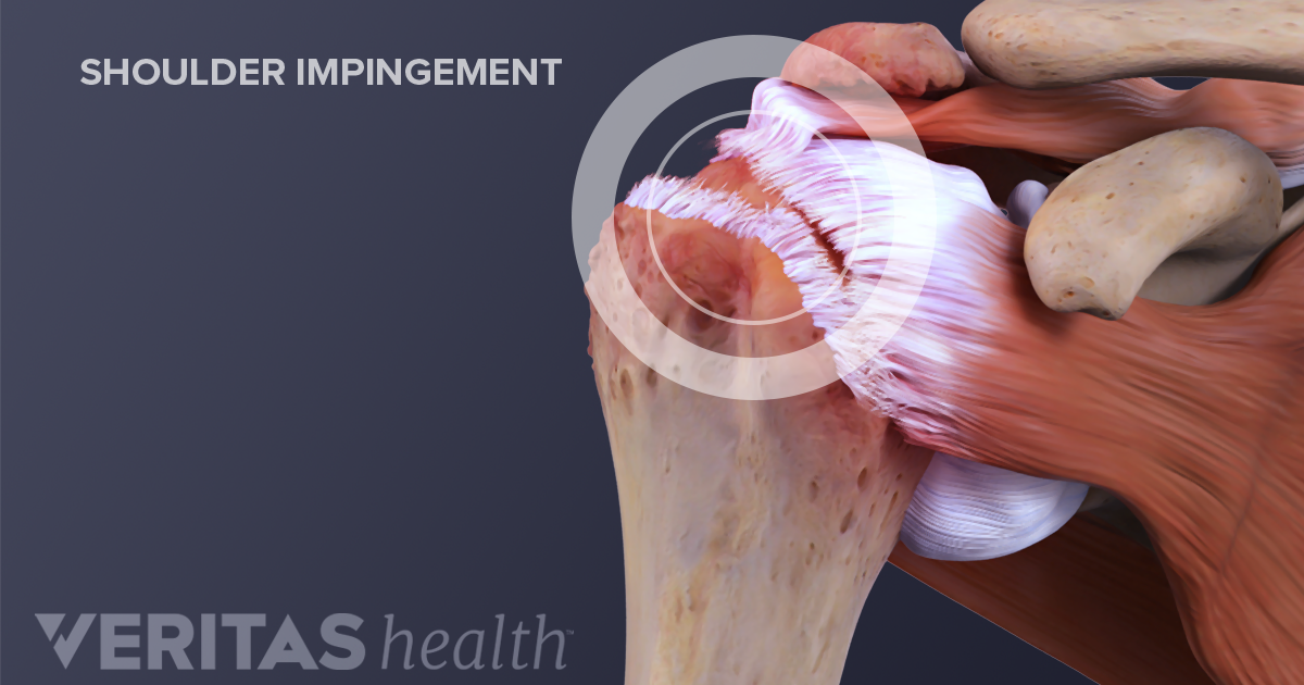 Shoulder Impingement Biceps Tendon 9855