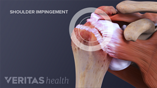 Decompression Surgery for Shoulder Impingement