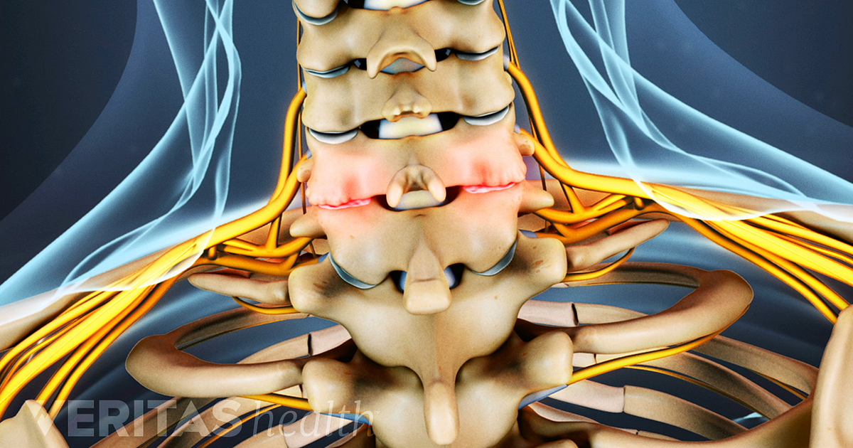Cervical Osteophytes: Bone Spurs in the 