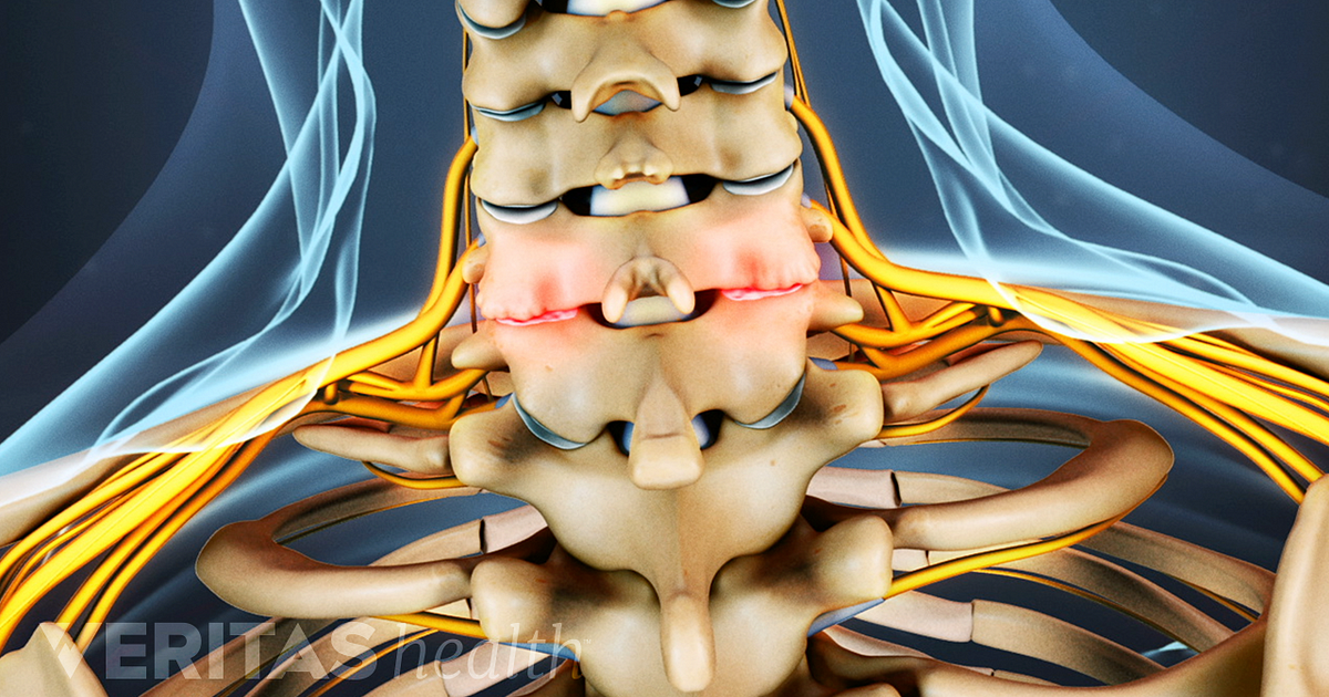 Cervical Osteophytes Bone Spurs In The Neck   Cervical Facet Osteoarthritis Bone Spurs 