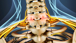 Posterior view of the cervical spine showing osteoarthritis.