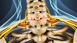 Posterior view of bone spurs in the cervical spine