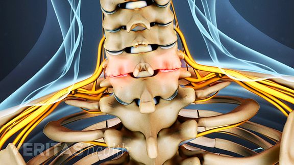 cervical spine arthritis x ray