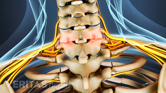 What You Need To Know About Neck Arthritis