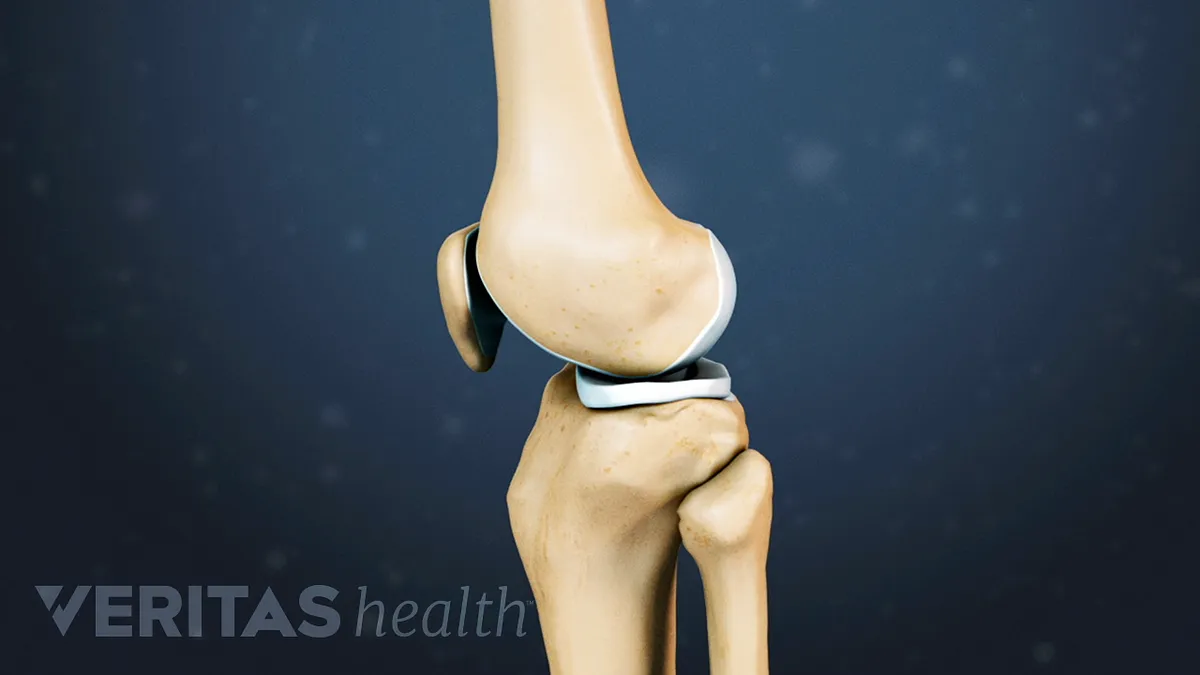 Ligament Injuries to the Knee - Stanford Medicine Children's Health