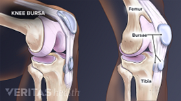 Knee bursitis showing the femur, bursae, and tibia.