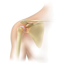 Shoulder-Arthritic