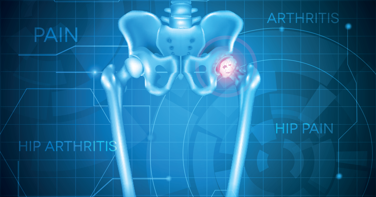 Hip Pain and Arthritis Hip Pain and Arthritis