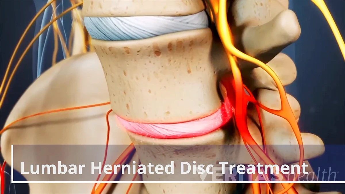 Lumbar Herniated Disc Treatment Video