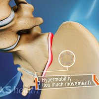 Animated video still of hypermobility in the sacroiliac joint