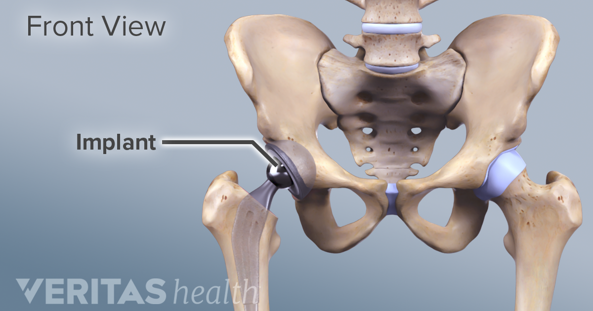 Sex Positions To Avoid After Hip Replacement thumbnail