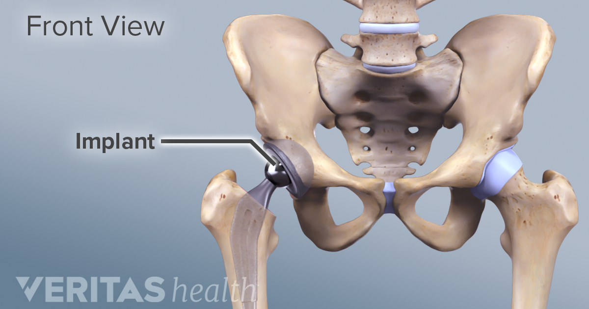 Birmingham Hip Vs Total Hip Replacement thumbnail