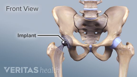 Is Minimally Invasive Hip Surgery Right for You?