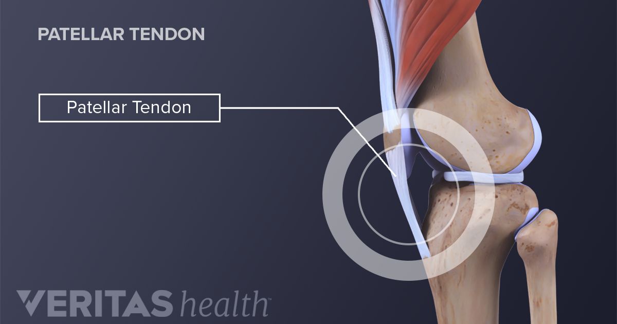 Patellar Tendinitis Definition | Sports Injury-Related Medical Glossary