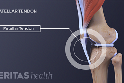 Symptoms of Kneecap Dislocation