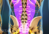 Highlighting the location of a lumbar laminectomy procedure in the lower back.
