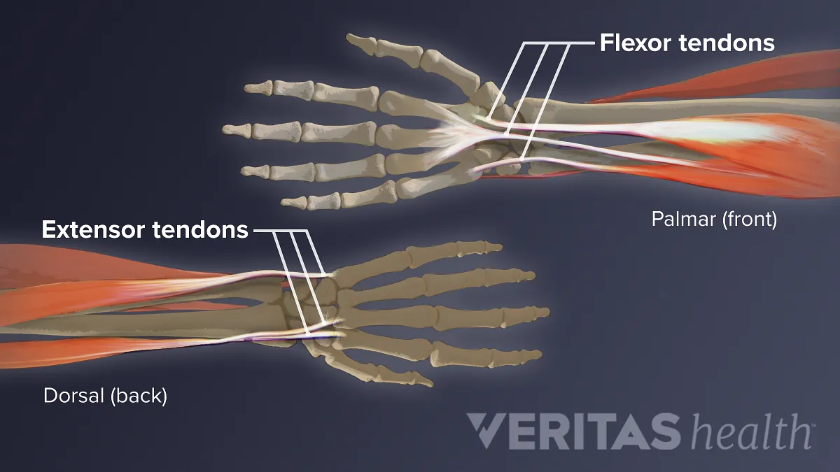 wrist extensor tendonitis
