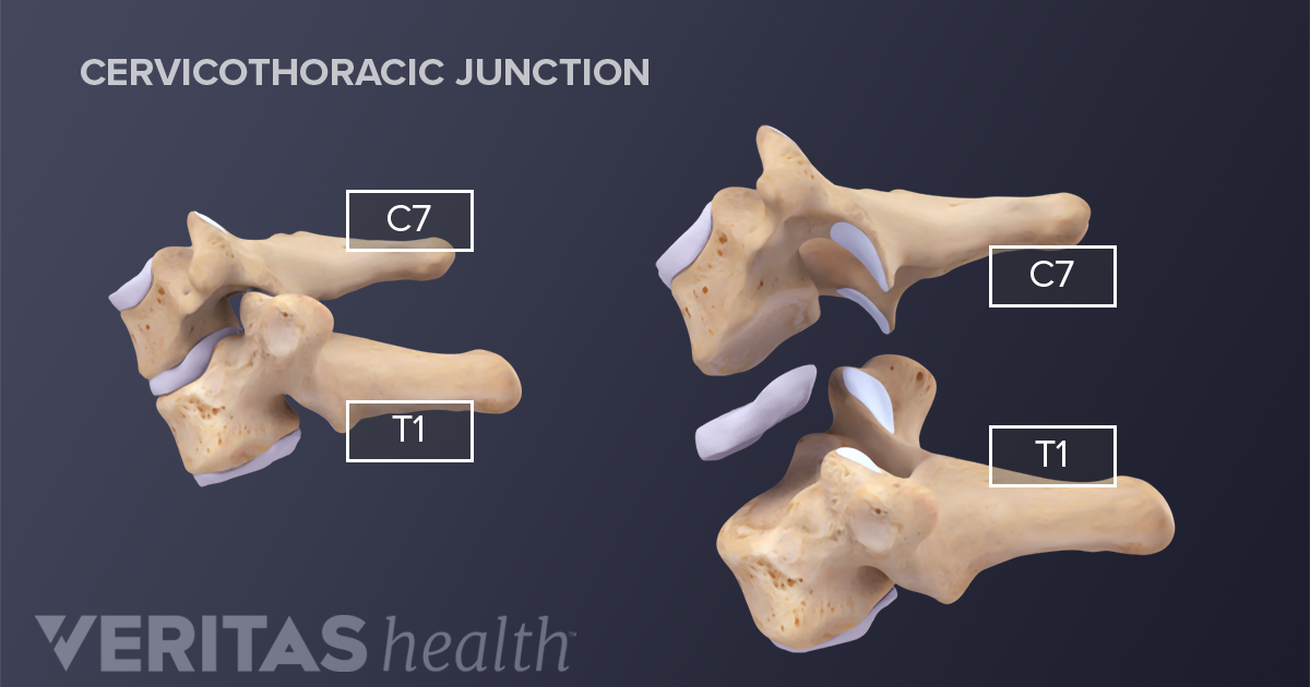 All About the C7-T1 Spinal Segment (Cervicothoracic Junction)