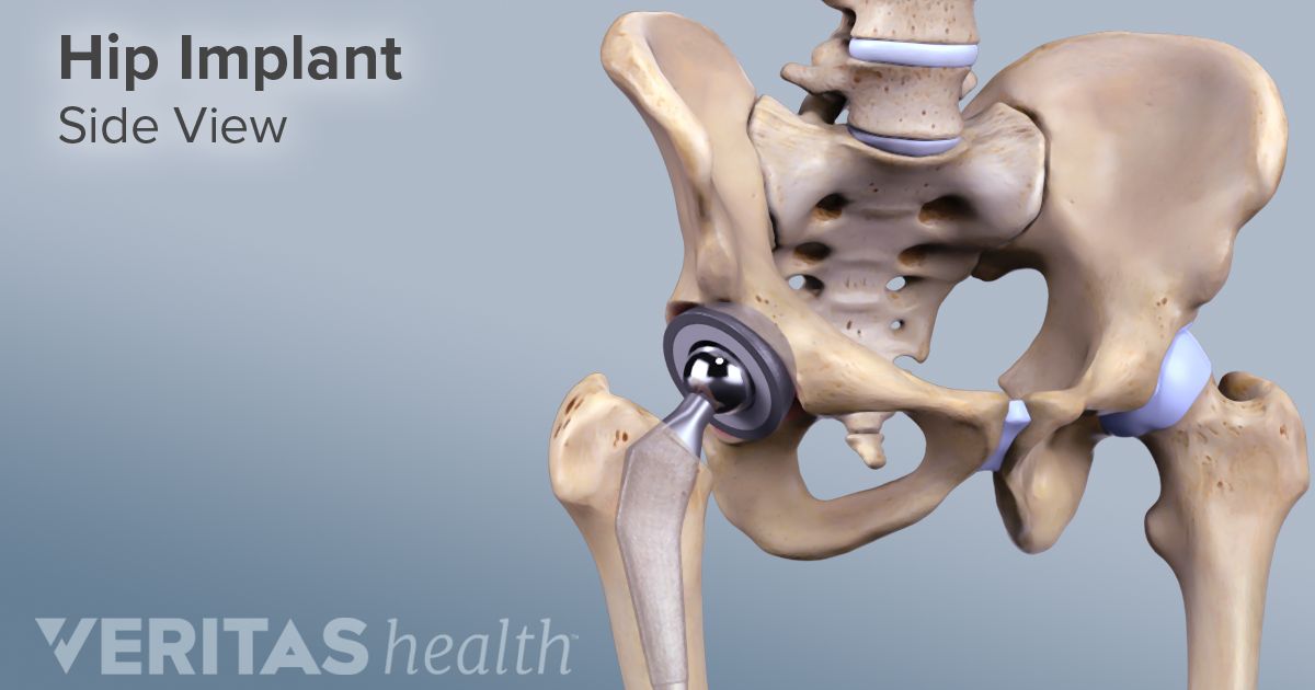 Cobalt Chrome Definition Back Pain And Neck Pain Medical Glossary   Side View Hip Arthroplasty 