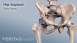 Medical illustration of side view of hip arthroplasty