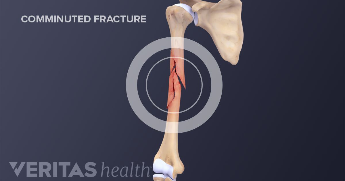 comminuted open fracture pictures