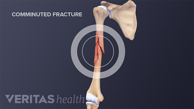 Comminuted Fracture Definition Back Pain And Neck Pain Medical Glossary