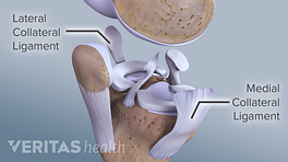 Profile view of the knee joint expanded to show the MCL and LCL.